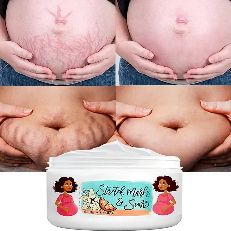 new arrival pregnancy tummy buttock abdominal scars removal,fat growth streaks lines removal,fast repairing stretch mark cream